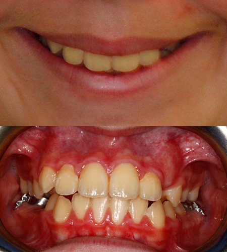 Clair before and after Orthodontics of San Mateo in San Mateo, CA