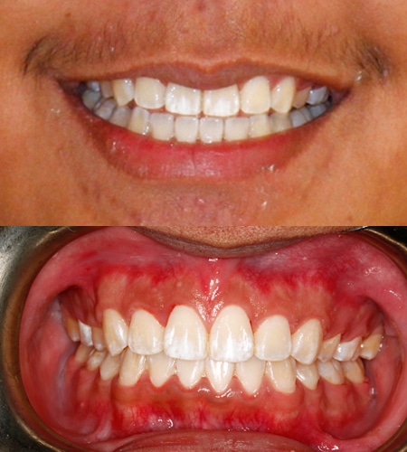Ronaldo Before and After Orthodontics of San Mateo in San Mateo, CA