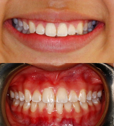 Before and After Orthodontics of San Mateo in San Mateo, CA