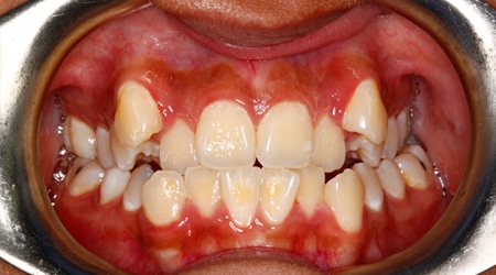 Before picture Orthodontics of San Mateo in San Mateo, CA