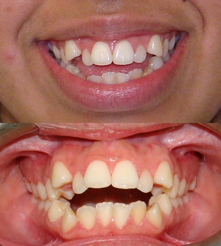 Maria before picture Orthodontics of San Mateo in San Mateo, CA