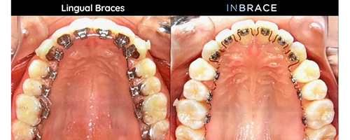 Lingual Brackets